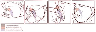 Case Report: A Preferred Reconstructing Modality to Restore Neoplastic Nasal Alar Subunit Defects: Sequential Facial Artery Perforator Flaps